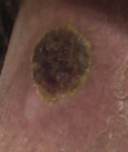 Skincancer1